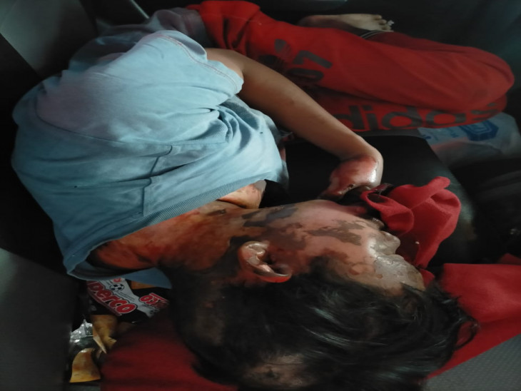 Tiga Kali ditolak RS, Korban Luka Bakar Akhirnya dibawa ke RSUD Bangkinang 